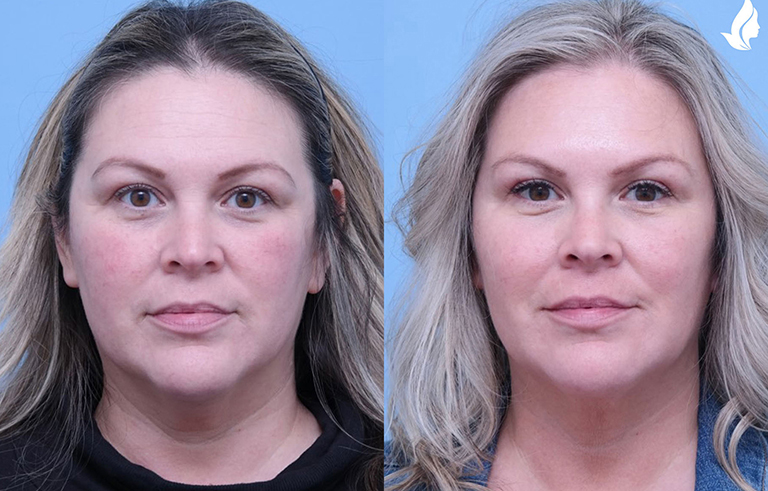 Injectable Fillers before and after photo by Midwest Facial Plastic Surgery in Minnesota