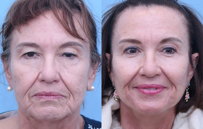 Laser Skin Resurfacing before and after photo by Midwest Facial Plastic Surgery in Minnesota