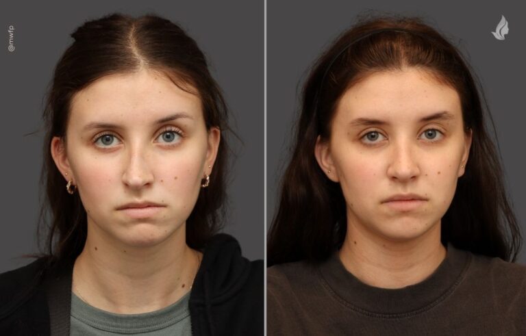 Rhinoplasty before and after photo by Midwest Facial Plastic Surgery in Minnesota