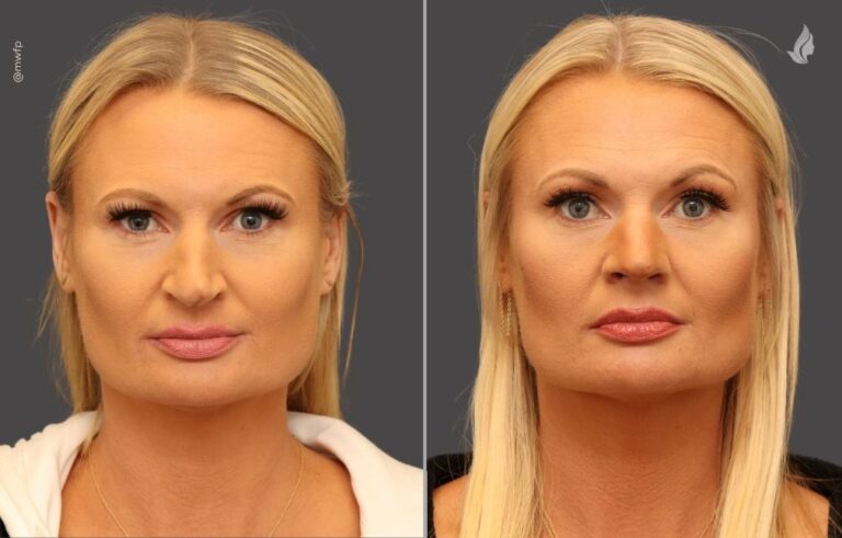 Rhinoplasty before and after photo by Midwest Facial Plastic Surgery in Minnesota