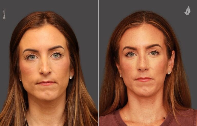 Rhinoplasty before and after photo by Midwest Facial Plastic Surgery in Minnesota