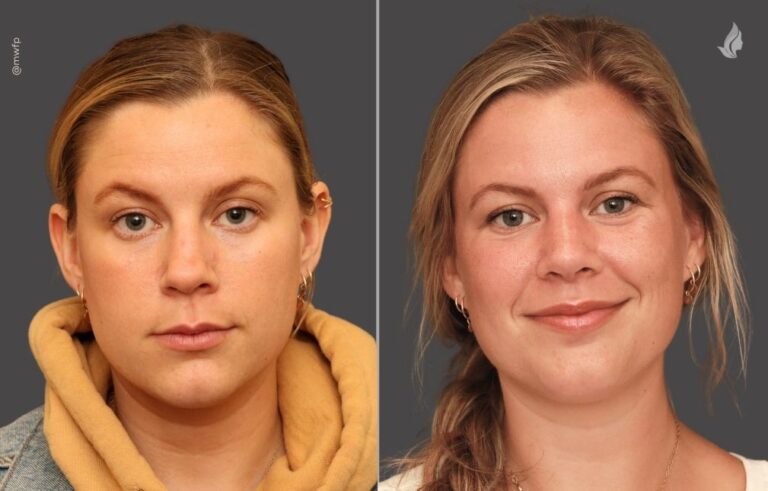 Rhinoplasty before and after photo by Midwest Facial Plastic Surgery in Minnesota
