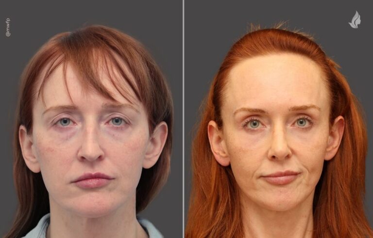 Rhinoplasty before and after photo by Midwest Facial Plastic Surgery in Minnesota