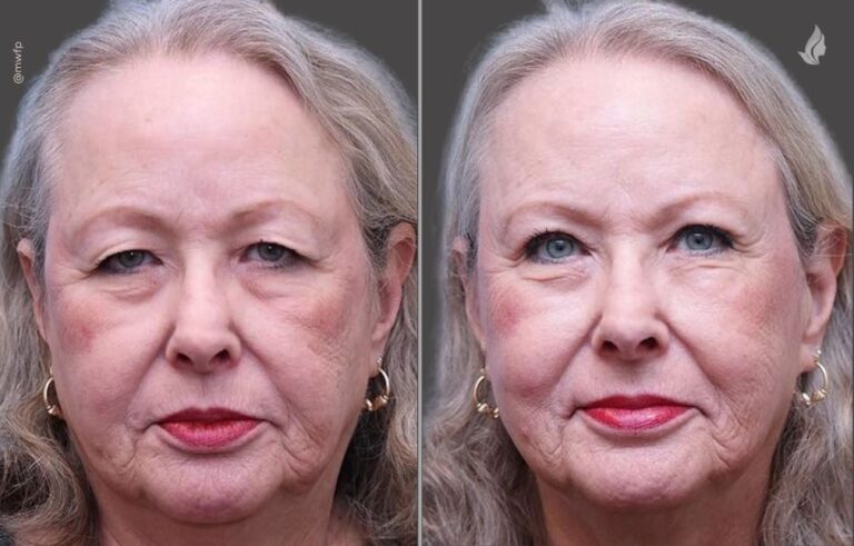 Blepharoplasty before and after photo by Midwest Facial Plastic Surgery in Minnesota
