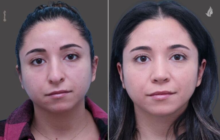 Rhinoplasty before and after photo by Midwest Facial Plastic Surgery in Minnesota