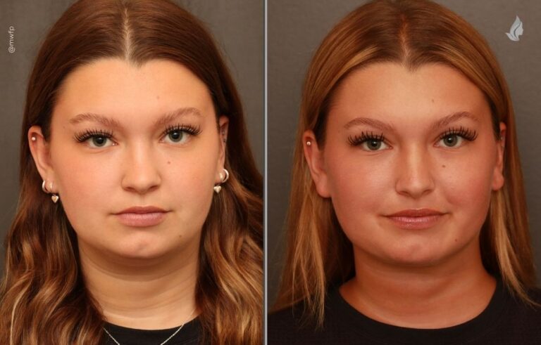 Neck lift before and after photo by Midwest Facial Plastic Surgery in Minnesota