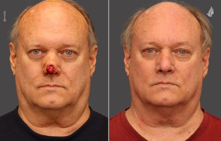 Mohs Reconstruction before and after photo by Midwest Facial Plastic Surgery in Minnesota