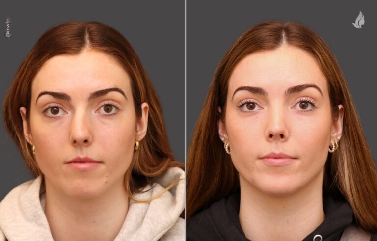 Rhinoplasty before and after photo by Midwest Facial Plastic Surgery in Minnesota
