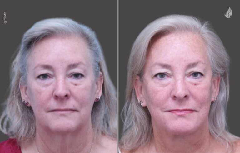 Facelift before and after photo by Midwest Facial Plastic Surgery in Minnesota
