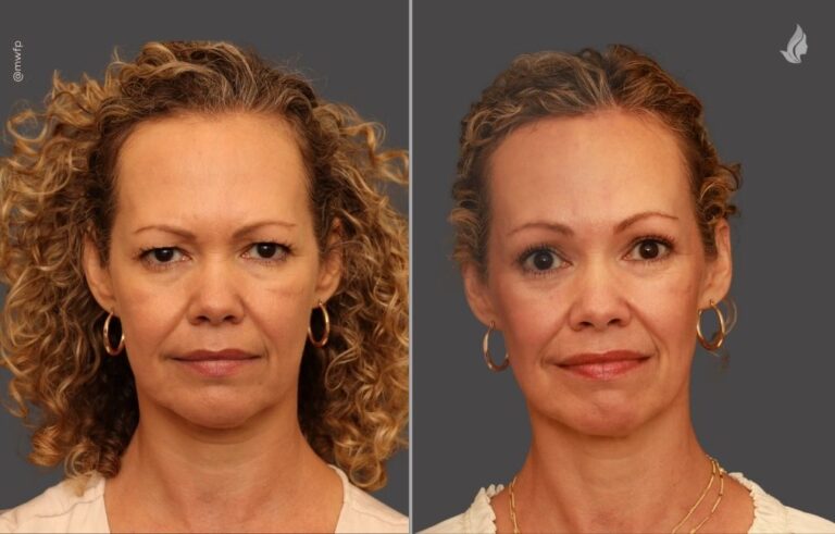 Brow Lift before and after photo by Midwest Facial Plastic Surgery in Minnesota