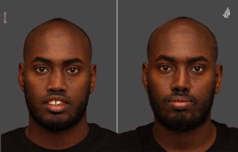 Rhinoplasty before and after photo by Midwest Facial Plastic Surgery in Minnesota