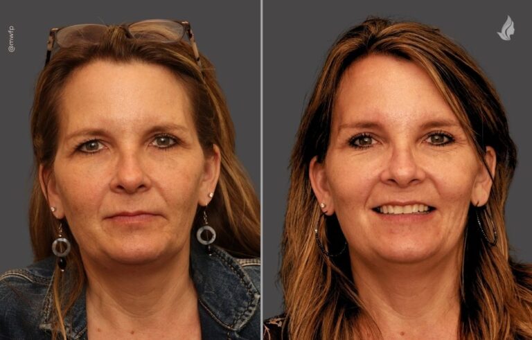 Blepharoplasty before and after photo by Midwest Facial Plastic Surgery in Minnesota