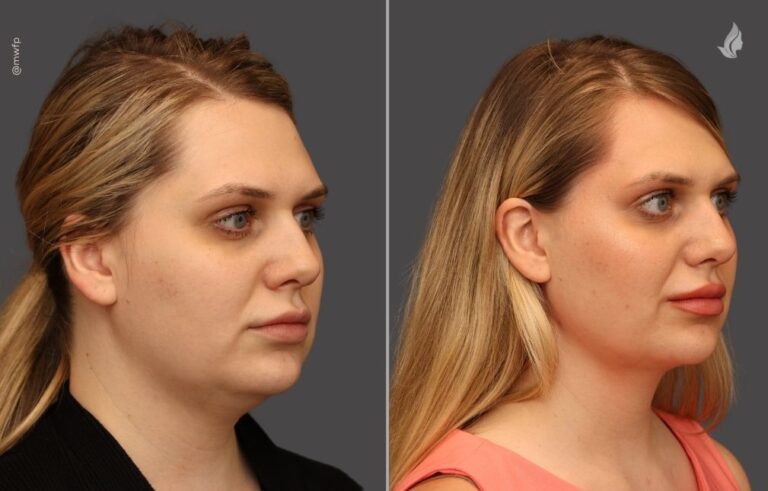Submental Liposuction before and after photo by Midwest Facial Plastic Surgery in Minnesota