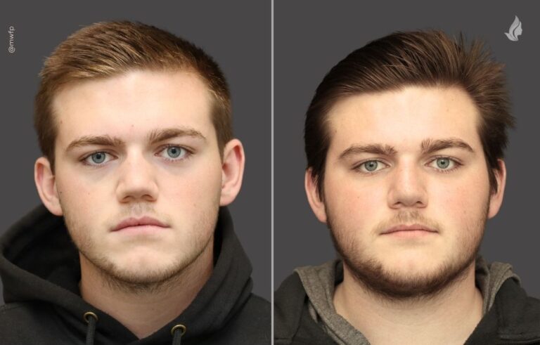 Rhinoplasty before and after photo by Midwest Facial Plastic Surgery in Minnesota