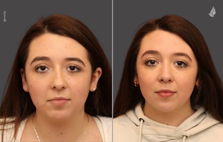 Rhinoplasty before and after photo by Midwest Facial Plastic Surgery in Minnesota