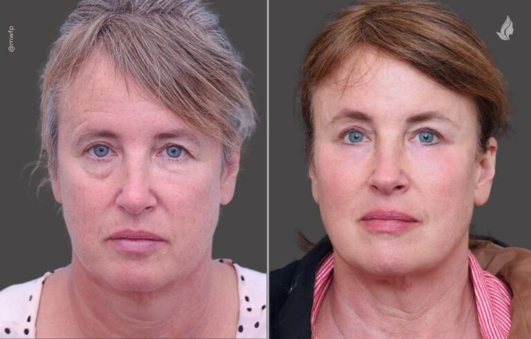Blepharoplasty before and after photo by Midwest Facial Plastic Surgery in Minnesota