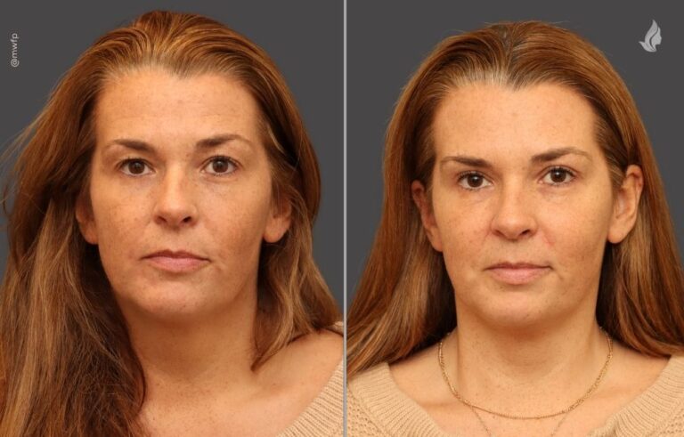 Blepharoplasty before and after photo by Midwest Facial Plastic Surgery in Minnesota