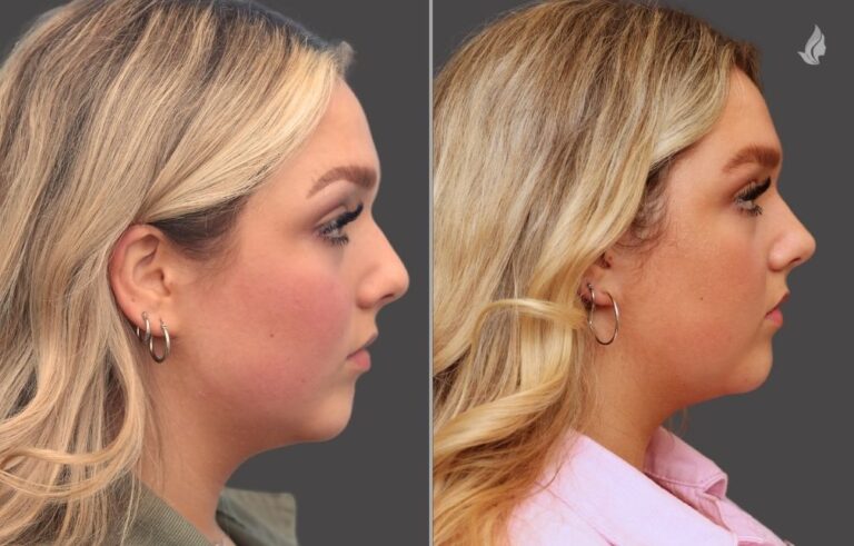 Liquid Rhinoplasty before and after photo by Midwest Facial Plastic Surgery in Minnesota