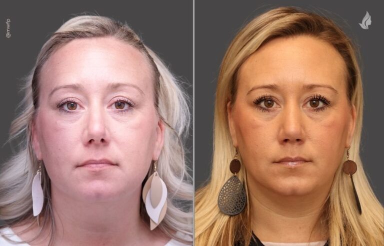 Rhinoplasty before and after photo by Midwest Facial Plastic Surgery in Minnesota