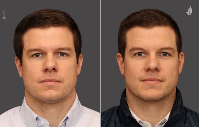 Botox before and after photo by Midwest Facial Plastic Surgery in Minnesota