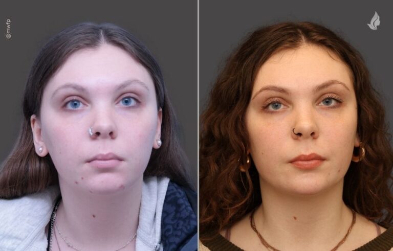 Chin augmentation before and after photo by Midwest Facial Plastic Surgery in Minnesota
