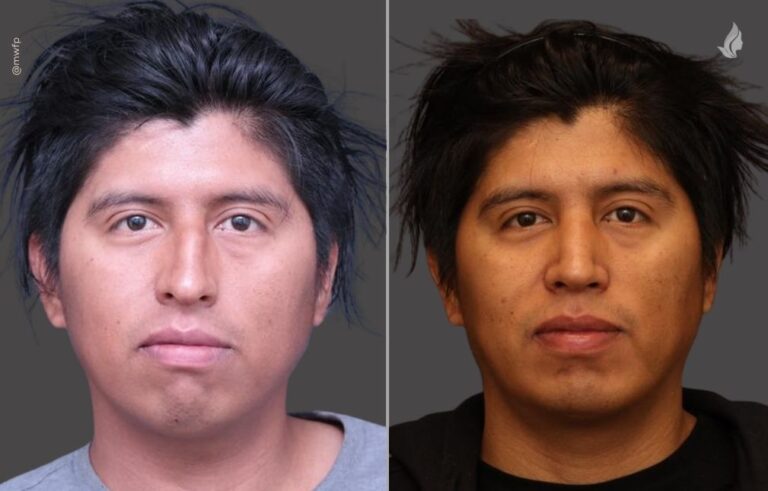 Rhinoplasty before and after photo by Midwest Facial Plastic Surgery in Minnesota