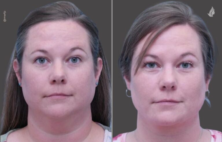 Neck lift before and after photo by Midwest Facial Plastic Surgery in Minnesota