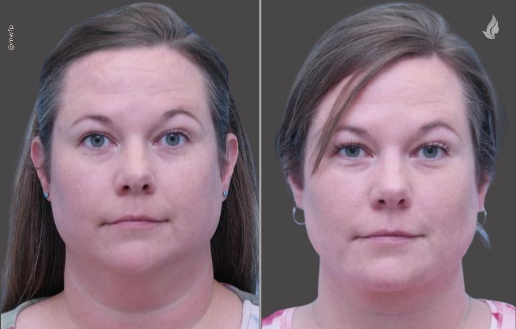 Neck lift before and after photo by Midwest Facial Plastic Surgery in Minnesota