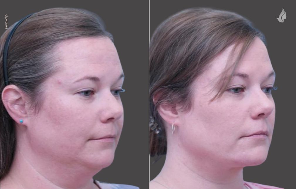 Neck lift before and after photo by Midwest Facial Plastic Surgery in Minnesota