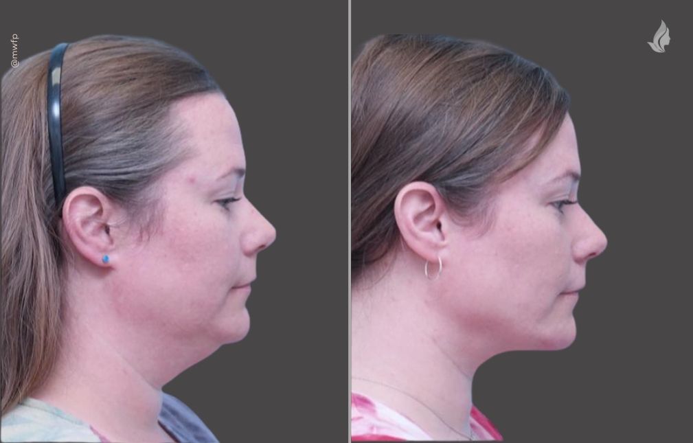 Neck lift before and after photo by Midwest Facial Plastic Surgery in Minnesota