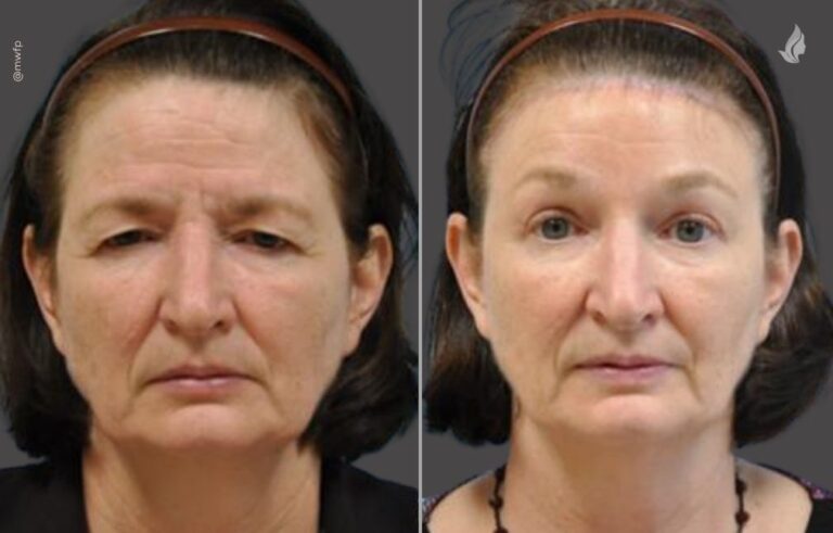 Blepharoplasty before and after photo by Midwest Facial Plastic Surgery in Minnesota