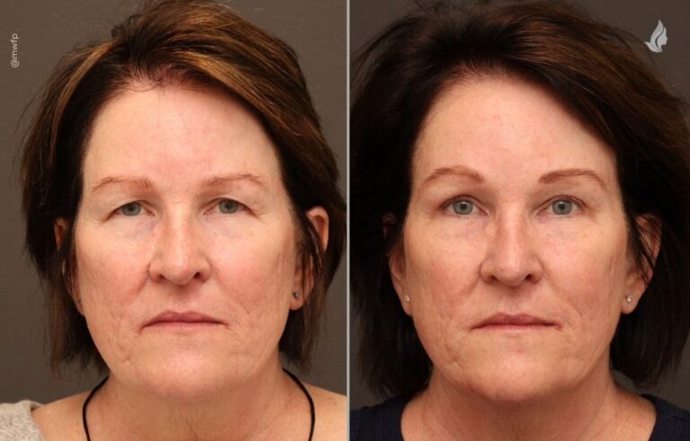 Brow Lift before and after photo by Midwest Facial Plastic Surgery in Minnesota