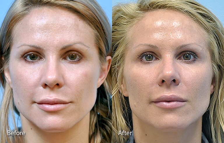 Injectable Fillers before and after photo by Midwest Facial Plastic Surgery in Minnesota
