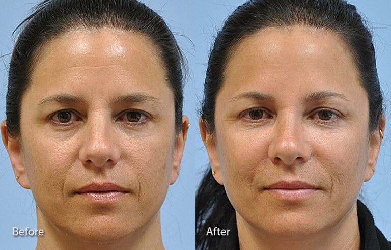 Injectable Fillers before and after photo by Midwest Facial Plastic Surgery in Minnesota