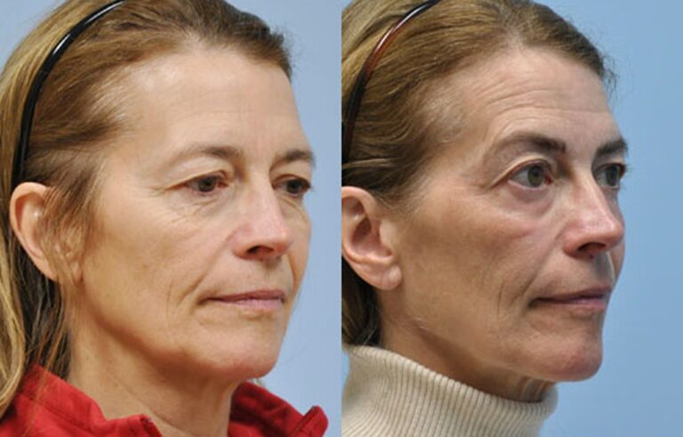 Laser Skin Resurfacing before and after photo by Midwest Facial Plastic Surgery in Minnesota
