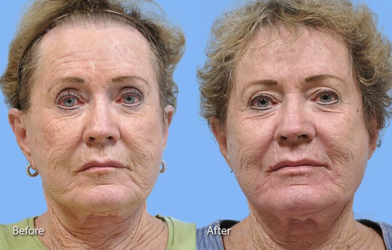 Laser Skin Resurfacing before and after photo by Midwest Facial Plastic Surgery in Minnesota