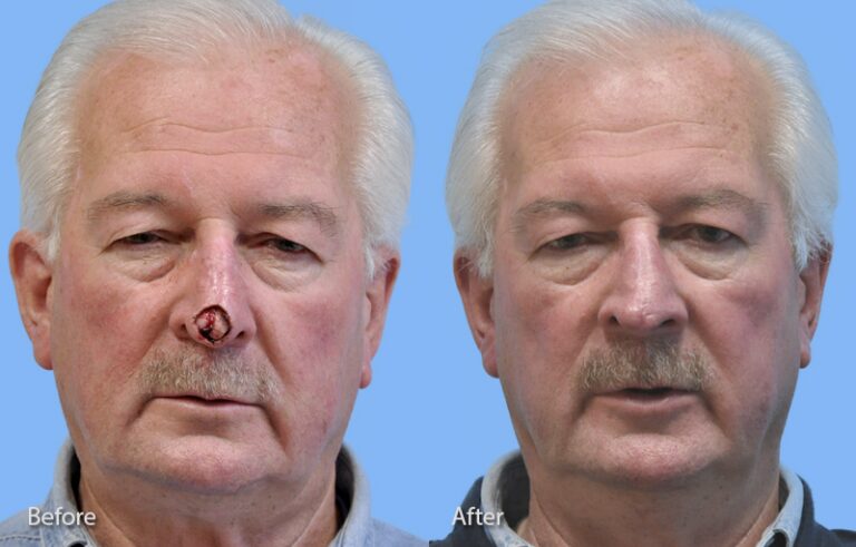 Mohs Reconstruction before and after photo by Midwest Facial Plastic Surgery in Minnesota x