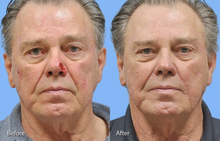 Mohs Reconstruction before and after photo by Midwest Facial Plastic Surgery in Minnesota x
