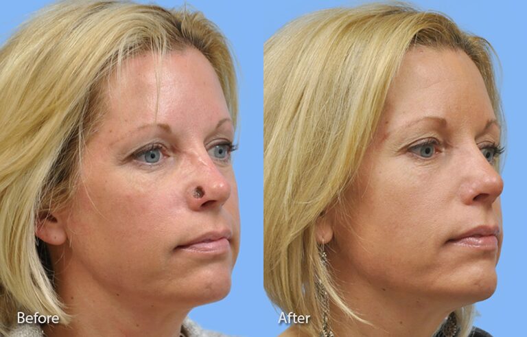 Mohs Reconstruction before and after photo by Midwest Facial Plastic Surgery in Minnesota