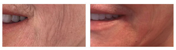 PLASMA IQ before and after patient