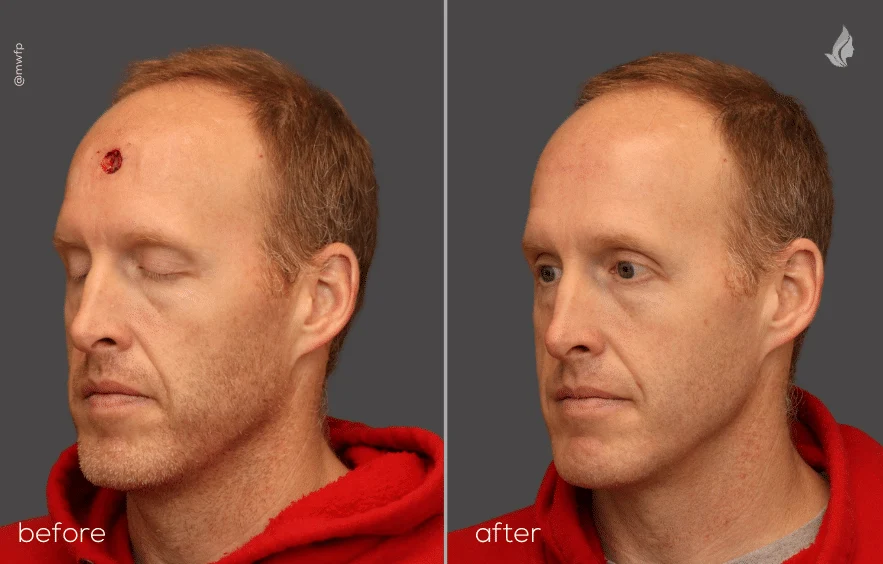 Mohs surgery before and after