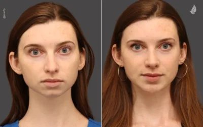 Facial Harmony: The Subtle Art of Natural-Looking Results