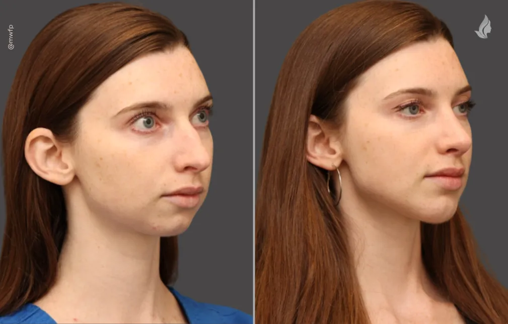 Rhinoplasty Chin Implants before and after photo by Midwest Facial Plastic Surgery in Minnesota
