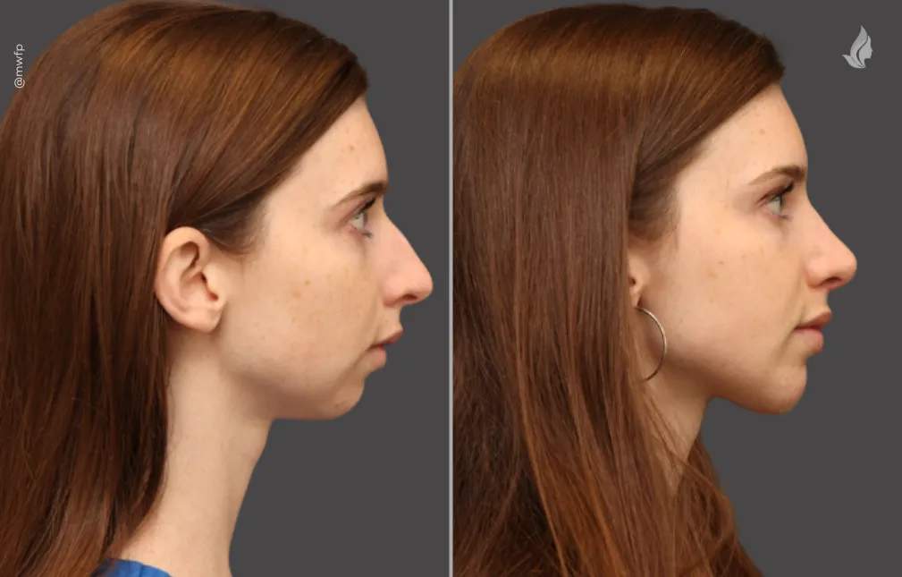 Rhinoplasty Chin Implants before and after photo by Midwest Facial Plastic Surgery in Minnesota