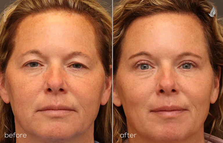 Dr. Bakeman patient Front profile endo brow and upper bleph
