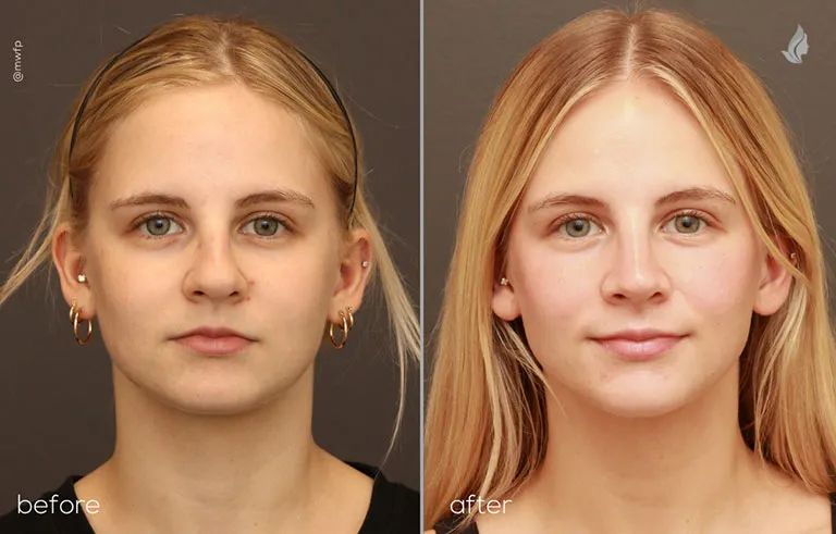 Dr. Bakeman patient Frontal Rhinoplasty