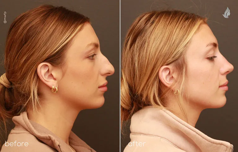 Dr. Bakeman patient profile Right before and after Rhinoplasty