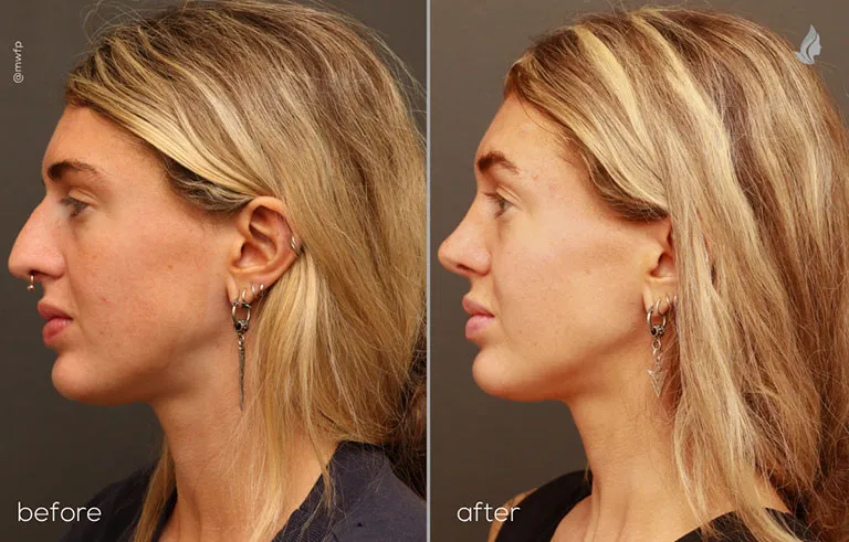 Dr. Bakeman patient profile left endoscopic brow lift, upper lid ptosis repair, rhinoplasty, and midface filler