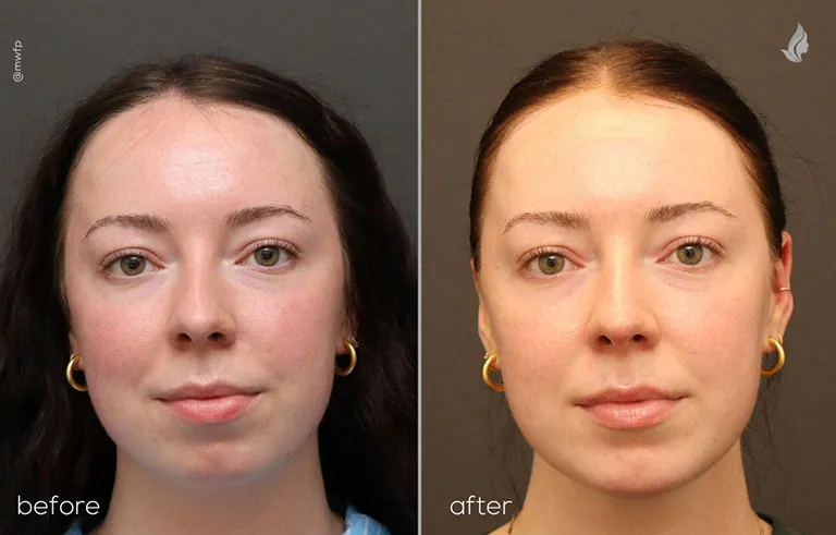 Front Profile before and after Chin Implant By Dr. Farhood