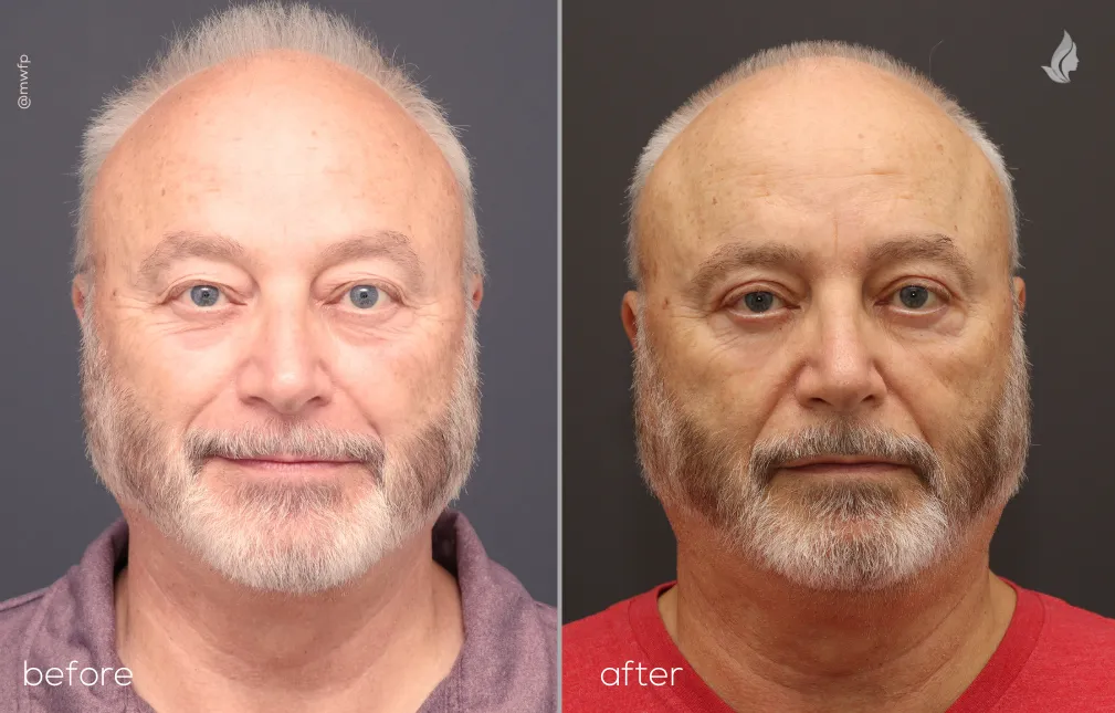 Front Upper Bleph By Dr. Farhood